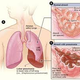 Illustration for article titled Penyakit Paru Paru Hitamem/em